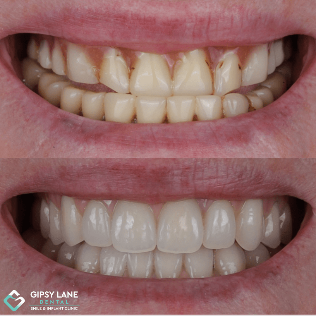 Are BPS Dentures Right for You