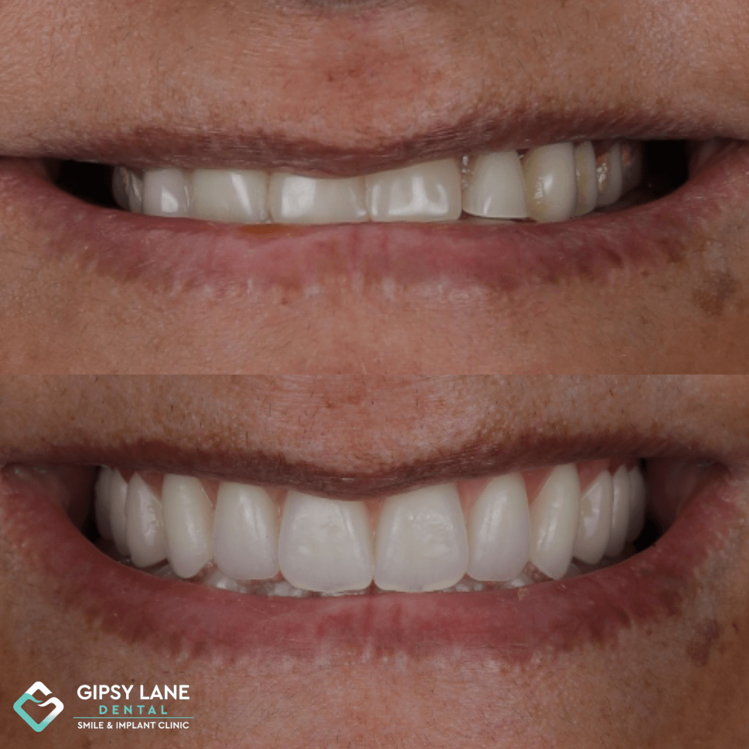 Are BPS Dentures Right for You