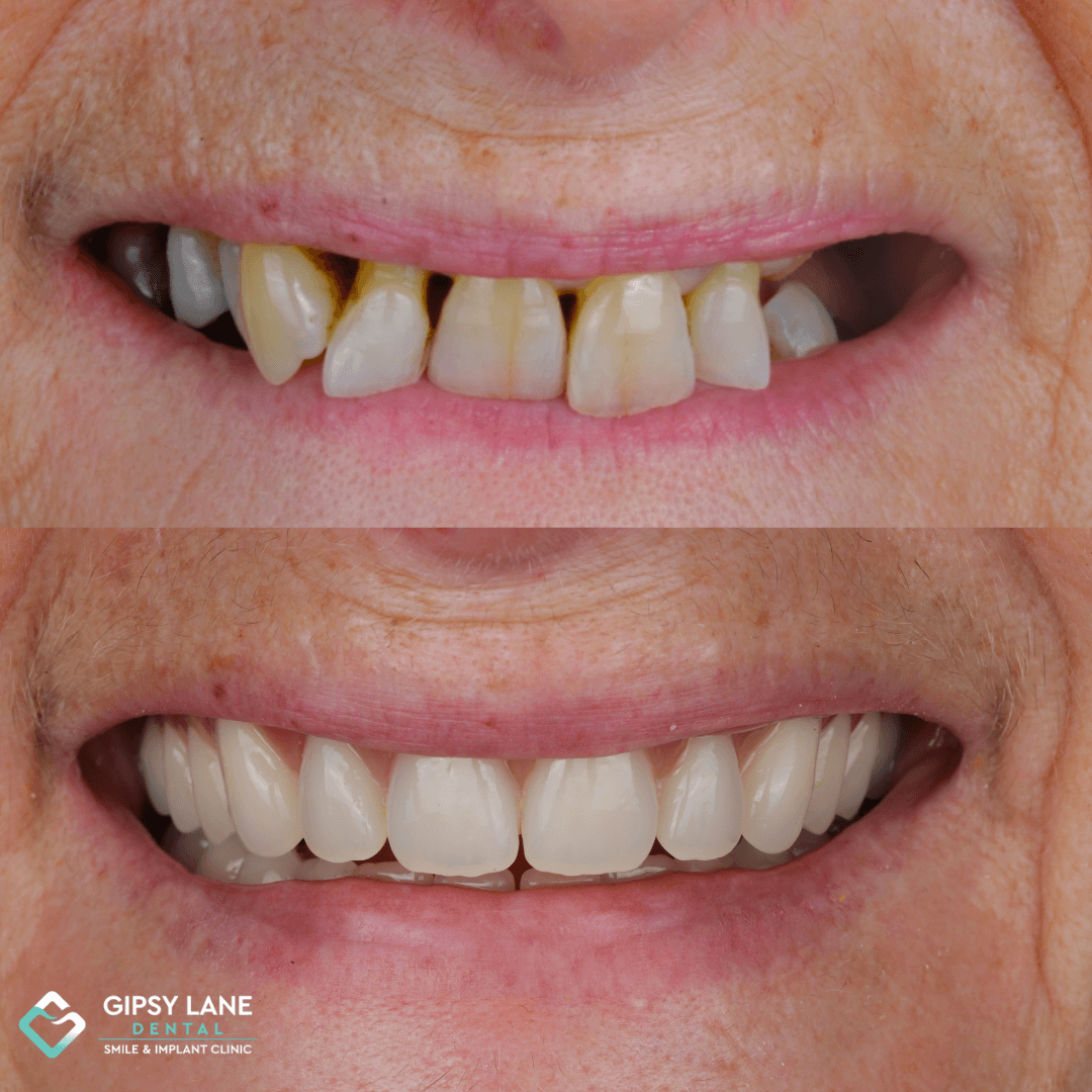 Are BPS Dentures Right for You