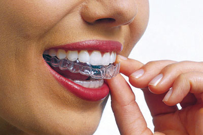 Invisalign Clear Aligners